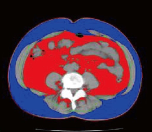内臓脂肪測定